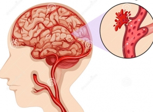 Nhồi máu não diện rộng là gì? Cách điều trị